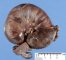 intestinal intussuspection on Meckel diverticula