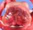Anencephaly (fetus, 19 weeks)