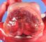 Anencephaly (fetus, 19 weeks)
