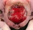 Anencephaly (40 weeks)