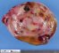 Clear cell sarcoma of the kidney (post-chemotherapy)