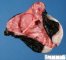 Congenital sacrococcygeal immature teratoma
