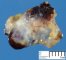 Glomangioma