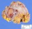 Localized neurofibroma in neurofibromatosis type 1