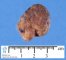 Colorectal juvenile polyp