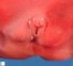 Male pseudhermaphrodism and XY intersex in Smith-Lemli-Opitz (...)