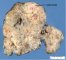 Sarcoma in mediastinal teratoma