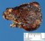 Leptomeningeal arteriovenous malformation