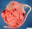 Velamentous insertion of umbilical cord