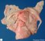 Pleural empyema