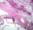 pleuropulmonary blastoma type 1