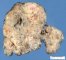 Sarcoma in mediastinal teratoma