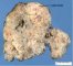 Mediastinal teratoma. Macroscopy