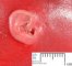 Microtia in trisomy 21 (21 weeks)