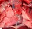 Dextrocardia, unique ventricule, pulmonary artery agenesis, bilateral (...)
