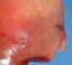 Microtia in trisomy 13