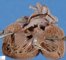 Ventricular septal defect