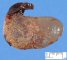 Amniotic sac