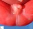 Anal imperforation