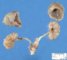 Bilateral simple renal hypoplasia (22 weeks)