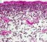Botryoid embryonal rhabdomyosarcoma of the rhinopharynx