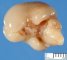 Fetal brain 12 weeks