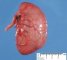 Colonic atresia
