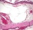 Colonic pneumatosis in cystic fibrosis