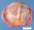 Fetus in amniotic sac