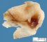 Parasplenic gastric duplication cyst (primitive foregut duplication (...)