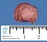 Intestinal myoepithelial hamartoma