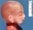 Macrocephaly (fetus, 20 weeks)