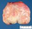 Ovarian fibrothecoma