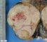Seminoma of the testis
