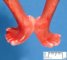 Rocker-bottom feet in trisomy 13