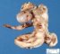 Unilateral multicystic renal dysplasia