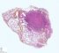 Pulmonary nodule in lymphomatoid granulomatosis