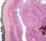 Mucoepidermoid carcinoma