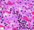 Parvoviral inclusion in fetal liver (hydrops fetalis)