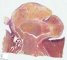 Submucosal uterine leiomyoma