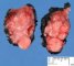 Thyroid papillary carcinoma