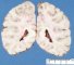 Choroid plexuses in lateral ventricles
