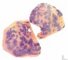Nodular sclerosing Hodgkin lymphoma