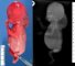 Assymetrical limb hypolasia