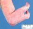 Ectrodactyly
