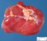 Myxoid liposarcoma