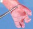 Hand oligodactyly