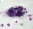 Gaucher cell in bone marrow cytology