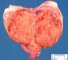 ovarian Leydig cell tumor