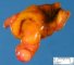 Meckel diverticula in intestinal lumen